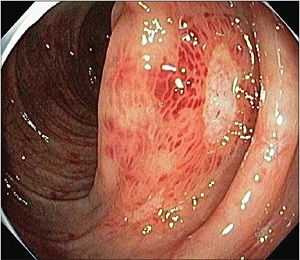 ヘノッホシェーンライン紫斑病 十二指腸・小腸の血管炎 ヘノッホシェーンライン紫斑病 十二指腸・小腸の血管炎